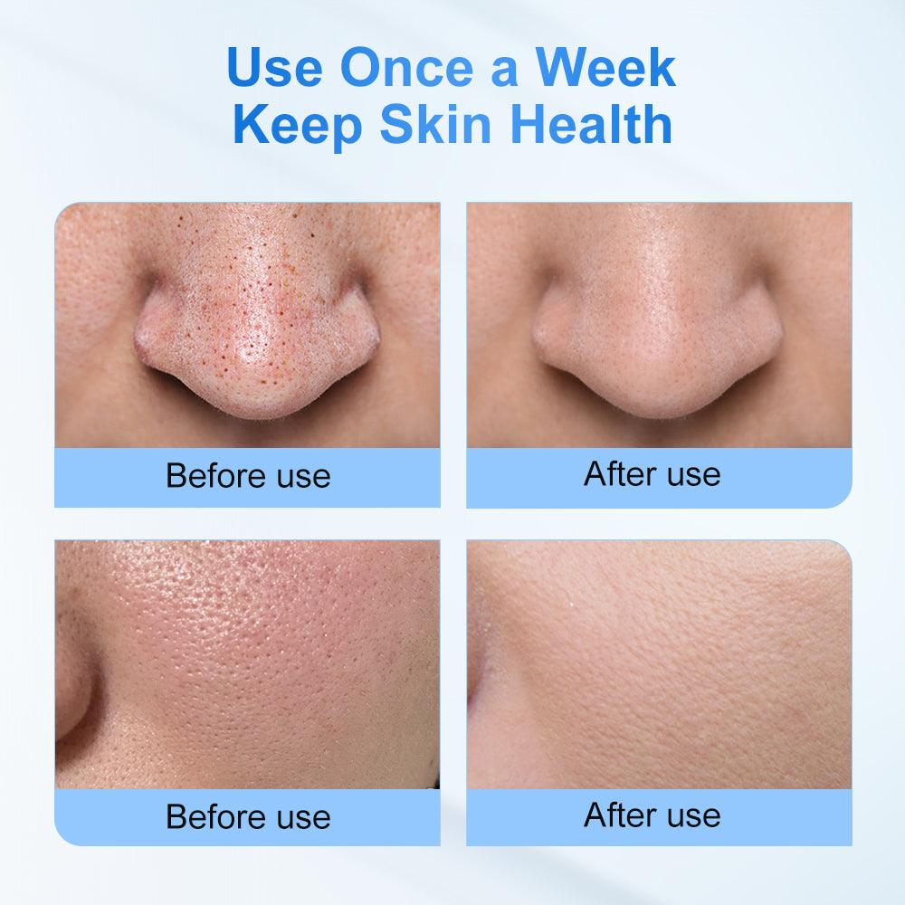 ANLAN Water Blackhead Remover