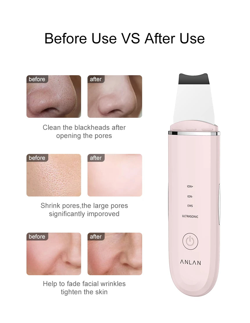 ANLAN Ultrasonic Skin Scrubber 4 Modes